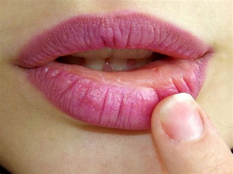 si mi pareja y yo tenemos herpes podemos tener relaciones|Tengo herpes labial ¿Puedo transmitirlo manteniendo relaciones。